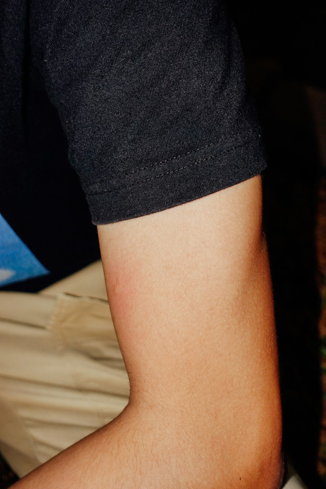 A red, raised area is visible on the arm